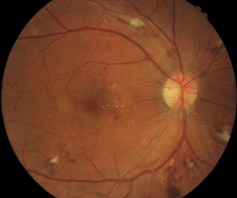 retinopatia diabetica clinica
